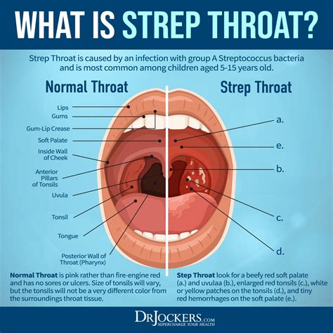 17 Best Images About Health On Pinterest Strep Throat Health And How