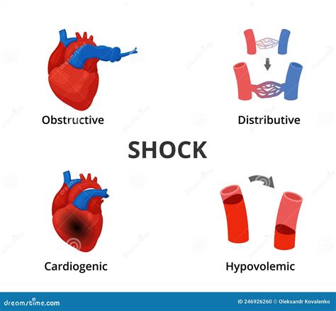 4 Types Of Shock Diagram Medical Emergency Infographics Stock Vector