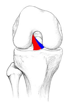 Acl Reconstruction Graft Configuration Glenview Illinois