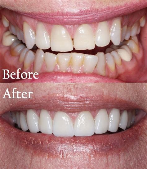 Before After Cosmetic Dentistry In Destin Pcb Navarre Fl