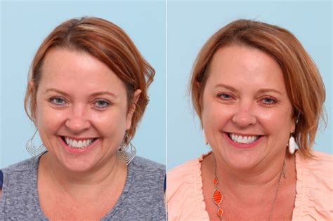 Botox Cosmetic Amp Xeomin Photos Houston Tx Patient 7767