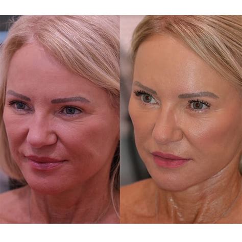 Botox Filler Destin Botox