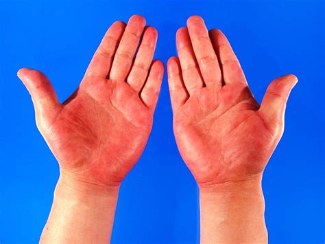 Bright Red Rash On Hands