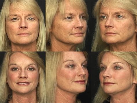 Brow Lift For Pensacola Fort Walton Beach Fl Destin Plastic Surgery