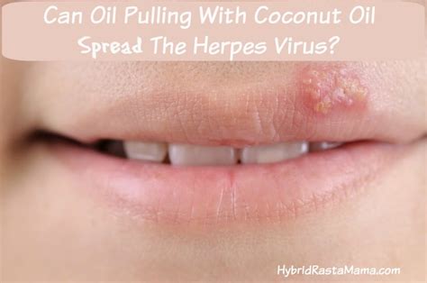 Can Oil Pulling With Coconut Oil Spread The Herpes Virus Hybrid