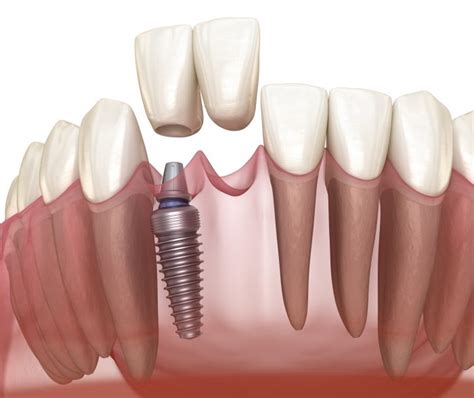 Can You Have A Dental Implant On A Front Tooth University Dental San