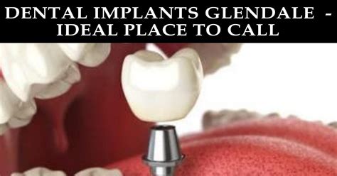 Dental Implants Glendale Ideal Place To Call Docx Docdroid