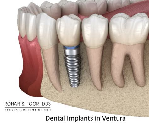 Dental Implants Ventura Ca California Cost Surgery Same Day