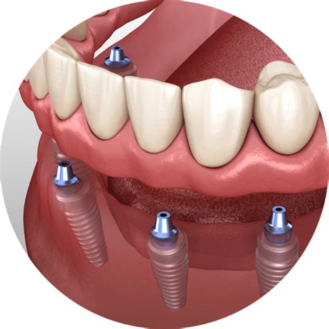 Denture Options In Crestview Implant Supported Dentures Niceville