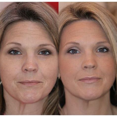 Dermal Fillers Amp Skincare Destin Botox