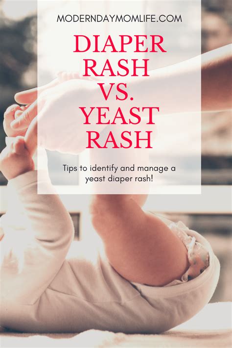 Diaper Rash Vs Yeast Infection How To Tell The Difference Amp Treat Both Diaper Rash Diaper