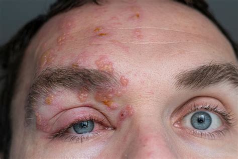 Early Symptoms Of Herpes Zoster