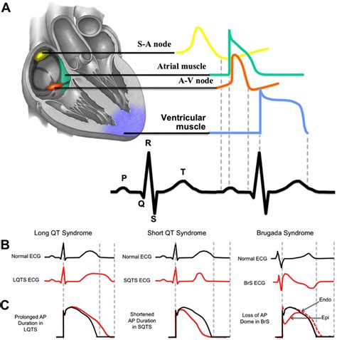 Electrical Impulse Problems In The Heart At Faye Langdon Blog