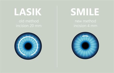 Everything You Need To Know About Lasik Eye Solutions Mumbai