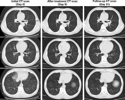 Frontiers Case Report Streptococcus Pneumoniae Pneumonia