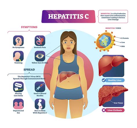 Hepatitis C Virus Causes And Risk Factors