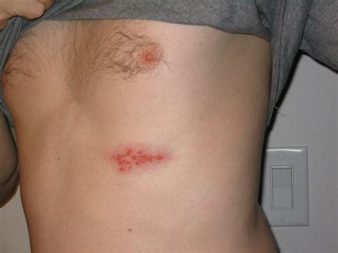 Herpes Zoster Infections