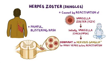 Herpes Zoster Nursing Osmosis Video Library