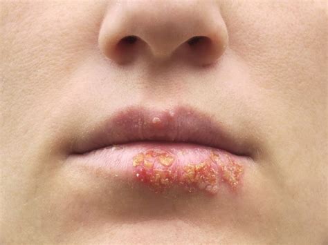 5 Ways Herpes Travels