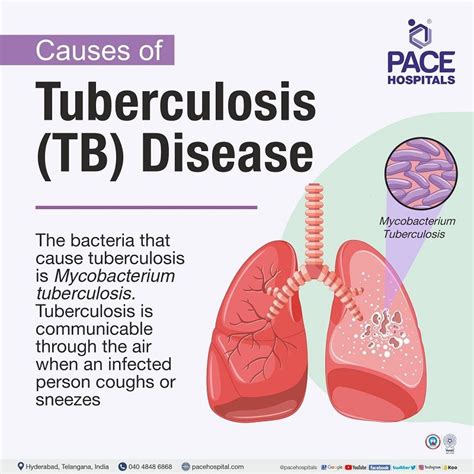 5 Ways TB Travels