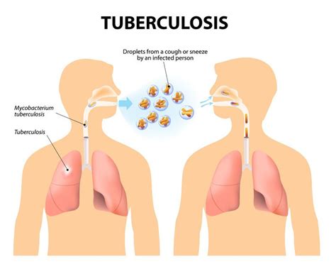 5 Ways TB Travels