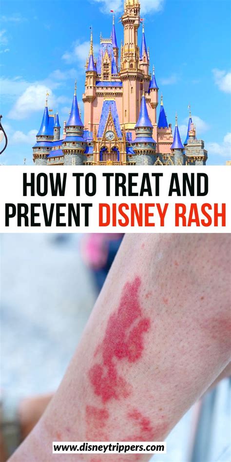 How To Treat And Prevent Disney Rash Disney Trippers In 2021 Disney Rash Usa Travel Guide