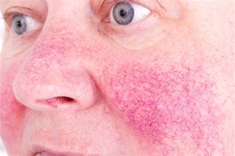 Identifying 21 Common Red Spots On Skin Universal Dermatology