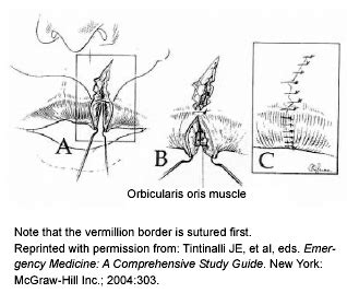 Inner Lip Laceration Management Infoupdate Org