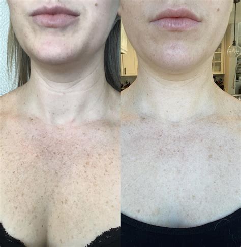 Ipl Before And After Pictures Case 62 Sacramento Ca Destination Aesthetics