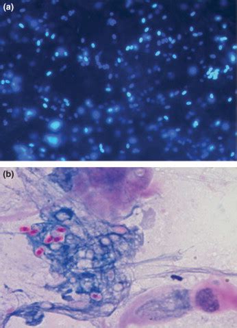 Is Microsporidial Keratitis A Seasonal Infection In India Clinical