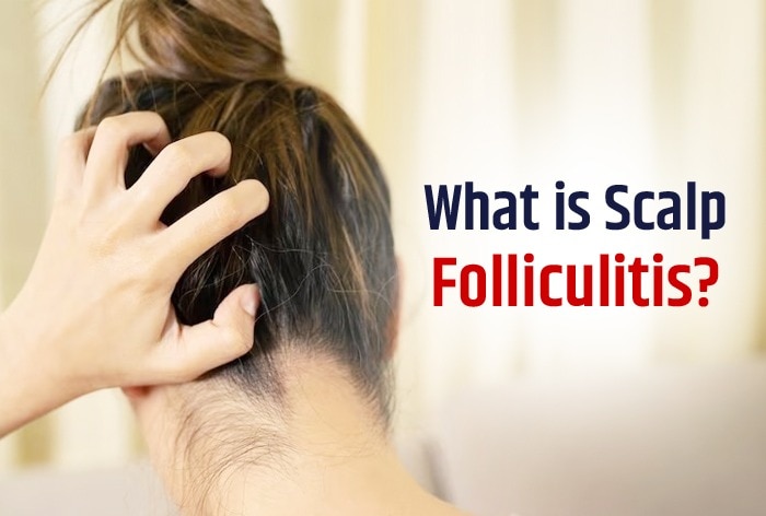 Itchy Hair Scalp 5 Worrisome Signs Of Scalp Folliculitis Check Its