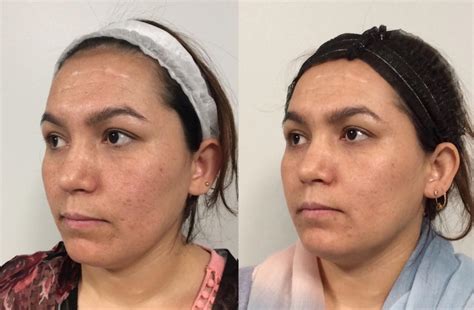 Microneedling Before And After Pictures Case 41 Sacramento Ca Destination Aesthetics