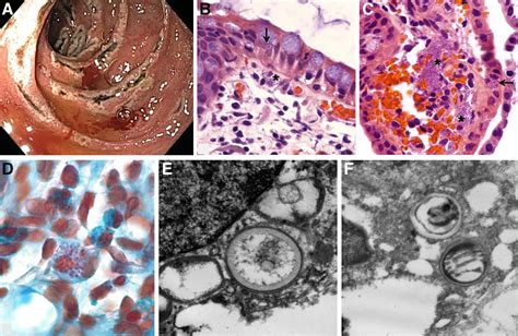 Microsporidiosis