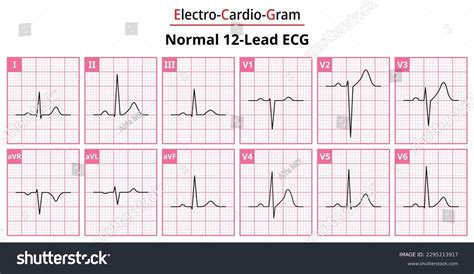 Normal 12 Lead Ecg Labeled