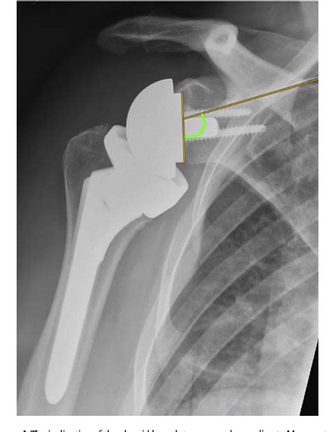 References In Functional Internal Rotation After Shoulder Arthroplasty