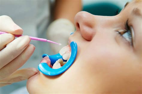 Sealants Protecting Your Child S Teeth From Potential Problems