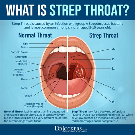 5 Ways Streptococcus Spreads