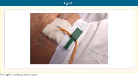 Suprapubic Tube And Or Catheter Change Catheter Catheter Insertion