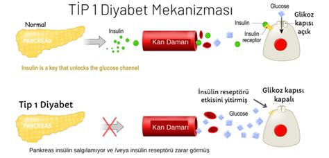 Tip 1 Diyabet Nedir Nas L Anla L R Tetra T P Laboratuvar