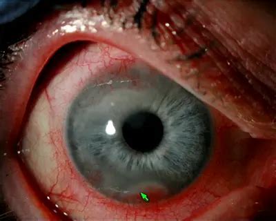 Varicella Zoster Virus Keratitis A Case Presentation American