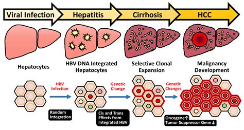 Viruses Free Full Text Impact Of Hepatitis B Virus Infection Non Alcoholic Fatty Liver