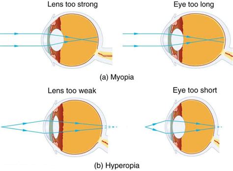 Vision Correction Physics