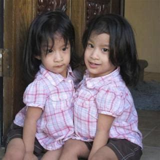 Your Health Partner Conjoined Twin Sisters Angelina And Angelica Sabuco From Philippines